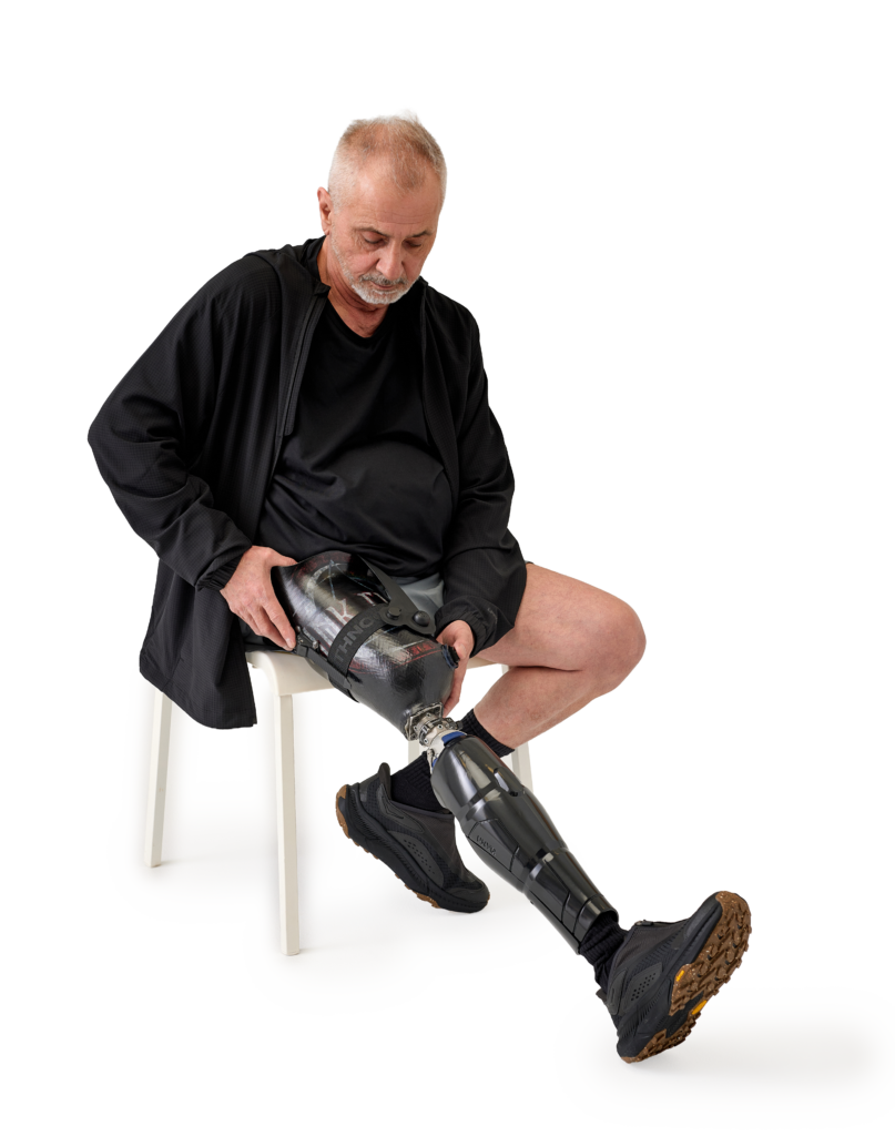 Patient wearing transfemoral prosthesis with an Overlay TF sleeve.